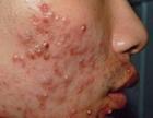 湿疹是怎么引起的？
