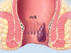 内痔形象图