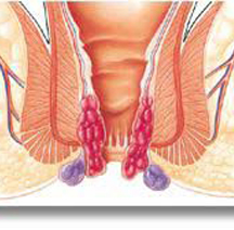 肛门湿疹