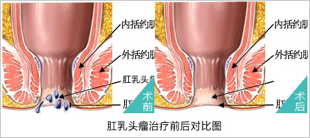 肛乳头瘤手术