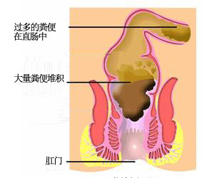 大便困难