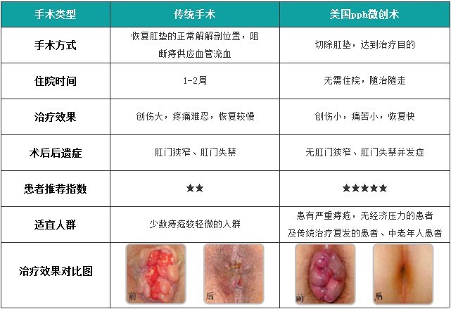 女性痔疮