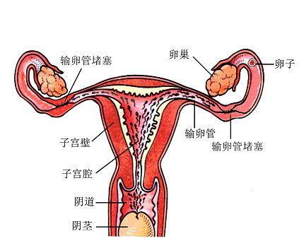 输卵管堵塞