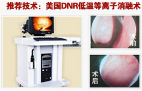 美国ＤＮＲ低温等离子消融术