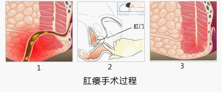 肛瘘手术过程