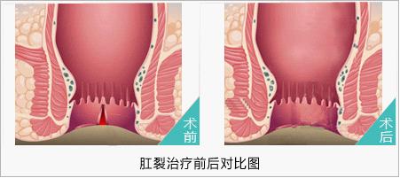 肛裂手术过程