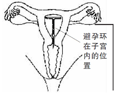 上避孕环