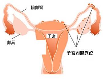 子宫内膜异位症